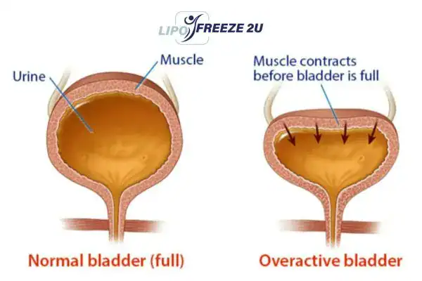 diagram of overactive bladder treatment Hertfordshire