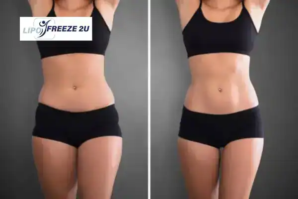 How Can LIPO FREEZE 2U Support Your Post-Pregnancy Body Recovery Hertfordshire?