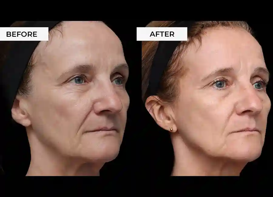 How Many RF Microneedling Sessions Will You Need to See a Difference Hertfordshire?