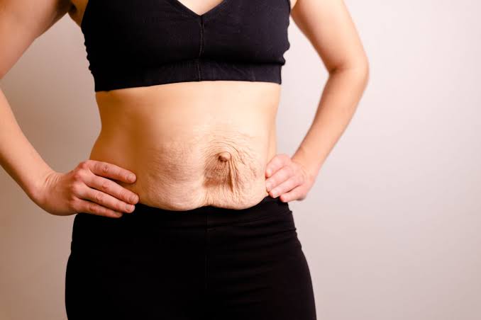 Is Surgery Really the Only Way to Repair Diastasis Recti Hertfordshire?