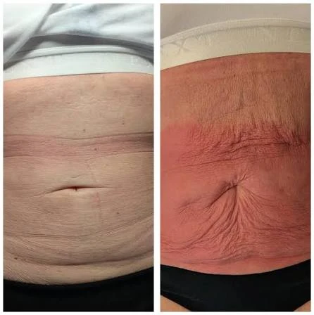 How Does RF Microneedling Improve Crepey, Thin and Uneven Skin Texture Hertfordshire?