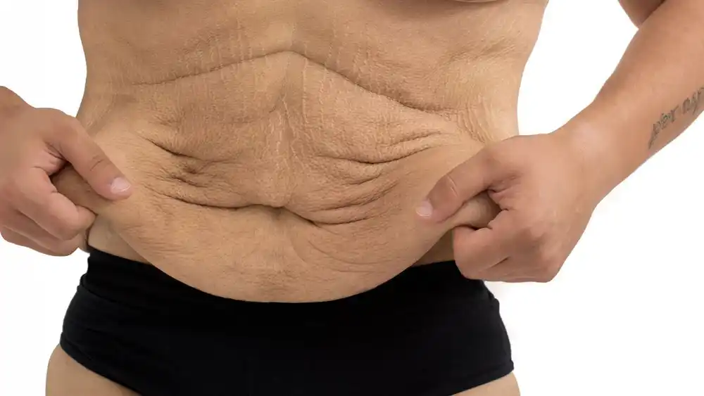 Why Does Weight Loss Medication Leave Some People With Loose or Sagging Skin Hertfordshire?